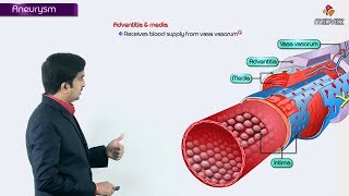 Pathophysiology of Aneurysms [upl. by Mathre55]