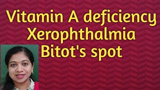 Xerophthalmia Vitamin A deficiency Bitots spot [upl. by Suzy]