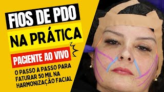 Aprenda tudo sobre Fios de PDO na Prática Procedimento AO VIVO [upl. by Gayla]