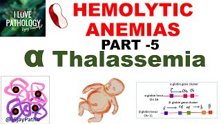 Hemolytic Anemias Part 5 Alpha Thalassemia Pathogenesis types Diagnosis amp Treatment [upl. by Refinnej960]