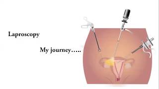 my laparoscopy journey in tamil [upl. by Mosby728]