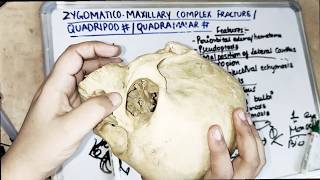 zygomatic bone fracture symptoms [upl. by Pacificia]