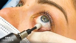 Eyelid Microexfoliation Cleanses Your Eyes [upl. by Rudie133]