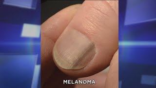 Subungual Melanoma What You Need to Know [upl. by Kerrill]