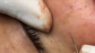 100TH TREATMENT Blackheads removal On The Face 2 [upl. by Linn880]