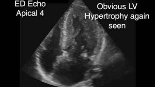 Hypertrophic Obstructive Cardiomyopathy with SAM [upl. by Lahtnero]