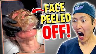 Peeling Off Faces with TOXIC Phenol Plastic Surgeon Reacts [upl. by Areem89]