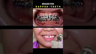 Braces for Gapped teeth 32 month Duration dentist braces orthodontist [upl. by Otter]