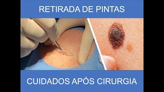 CUIDADOS APÓS CIRURGIA PARA REMOÇÃO DE PINTA [upl. by Aillimat]