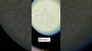 Hemolysis in RBC [upl. by Thgiwd]