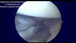 Radial lateral meniscus repair with box stitch techniqueEnglish [upl. by Particia994]