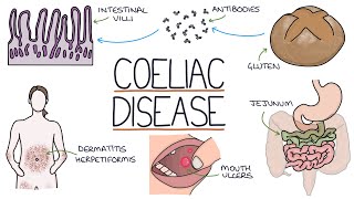 EARLY DIAGNOSIS  COELIAC UK [upl. by Eilarol]