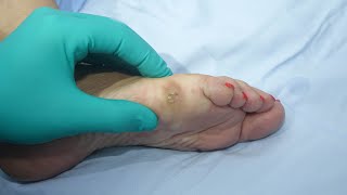 Klavus ili kurje oko stopala i trajno uklanjanje  Feet corns and their permanent removal [upl. by Ion]