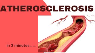 Atherosclerosis in 2 minutes [upl. by Feil]