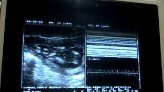 Miscarriage or spontaneous retained abortion 13 weeks [upl. by Nylidam262]