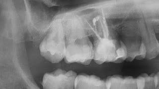 Root canal treatment on a first molar with a deep distal caries [upl. by Javed439]