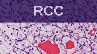 Renal Cell Carcinoma  Pathology mini tutorial [upl. by Aikemit]