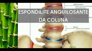 ESPONDILITE ANQUILOSANTE Evolução da Doença na Coluna Vertebral Clínica Fisioterapia Dr Robson Sitta [upl. by Deuno]