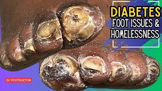 Diabetes Foot Issues and Homelessness [upl. by Asemaj153]