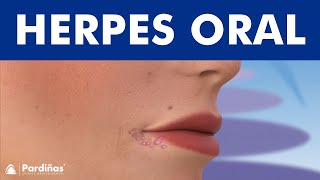 HERPES LABIAL o calentura  ¿Qué es y cómo se contagia © [upl. by Anialeh211]