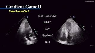 〖Echocardiography〗 Where is the gradient 💘 💫 [upl. by Stephenie216]