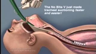 Using Intersurgicals TrachSeal™ closed suction systems [upl. by Marylynne]