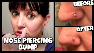 How To Get Rid Of A Nose Piercing Bump FAST  Keloid 📍 How To With Kristin [upl. by Colin]