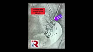 What does Recovery after an Ovarian Cyst Removal look like  TheFibroidDoc  Dr Cheruba Prabakar [upl. by Inafit]