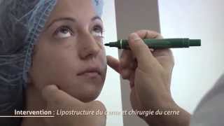 Chirurgie des cernes  Lipostructure du cerne [upl. by Rochus]