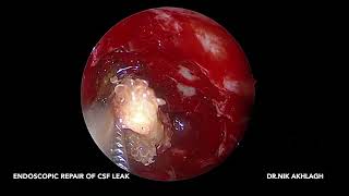 Endoscopic repair of cribriform plate CSF leak by Prof S Nikakhlagh [upl. by Inot]