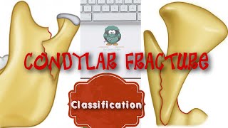 CONDYLAR FRACTURE CLASSIFICATION [upl. by Akiaki383]