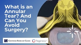 What is an Annular Tear And How Do You Treat It Without Surgery [upl. by Henig798]