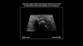 Plantar plate enthesopathy on dynamic foot ultrasound [upl. by Drugi743]