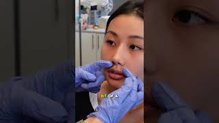 Lip Flip with Botox and Master Muscle Botox [upl. by Catherine326]