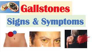 Gallstones Signs amp Symptoms Why They Occur  Cholecystitis Choledocholithiasis Cholangitis [upl. by Matless]