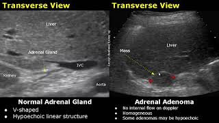 Adrenal Gland Cancer Causes Symptoms Diagnosis and Treatment [upl. by Nattirb]