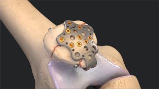 Rotator Cuff Shoulder Surgery [upl. by Moyra]