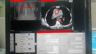 PROTOCOLO DE TÓRAX  ANGIOTOMOGRAFIA DE AORTA TORÁCICA [upl. by Ariayek363]