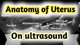 Sonographic Anatomy of UterusGyneacological ultrasound [upl. by Llertnek86]