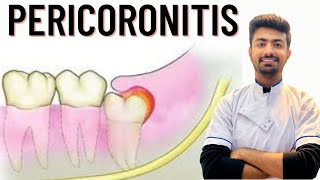 Pericoronitis Causes  Treatment [upl. by Asssilem]