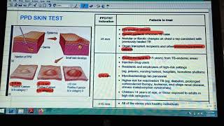 PPD SKIN test or Mantoux Test interpretation [upl. by Tahp536]