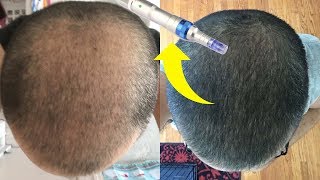 BEST MICRONEEDLING DEVICE FOR HAIR GROWTH [upl. by Eniamreg59]