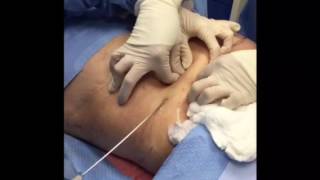 Tumescent Liposuction for Fat Removal [upl. by Ldnek]