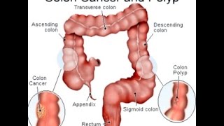 Colon Cancer [upl. by Nitsoj]