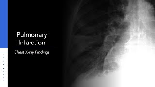 Pulmonary Infarction Chest Xray Hamptons Hump [upl. by Baerman]