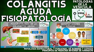 COLANGITIS FISIOPATOLOGÍA  GuiaMed [upl. by Charry]