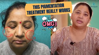 Melasma Treatment  Pigmentation Treatment in Delhi by Dr Jangid  Patient Testimonial  SkinQure [upl. by Riay]