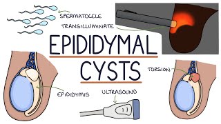 Understanding Epididymal Cysts [upl. by Varin684]