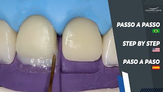 Diastema and Incisal Increase I Diastema y Alargamiento Incisal I Diastema e Aumento Incisal [upl. by Elleneg237]