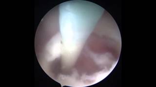 ENDOSCOPIC SEPTUM PELLUCIDUM FENESTRATION [upl. by Annahaj40]